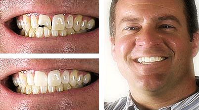 Composite Bonding For Teeth - Dental Treatments